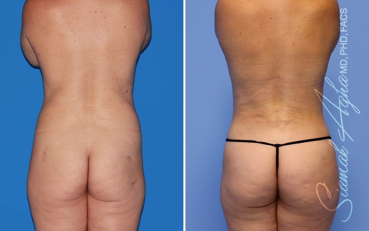 Mommy Makeover Before & After