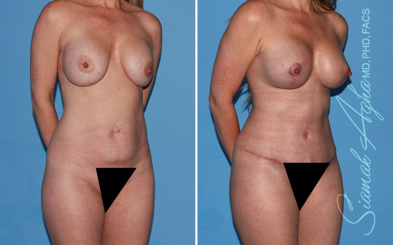 Mommy Makeover Before & After