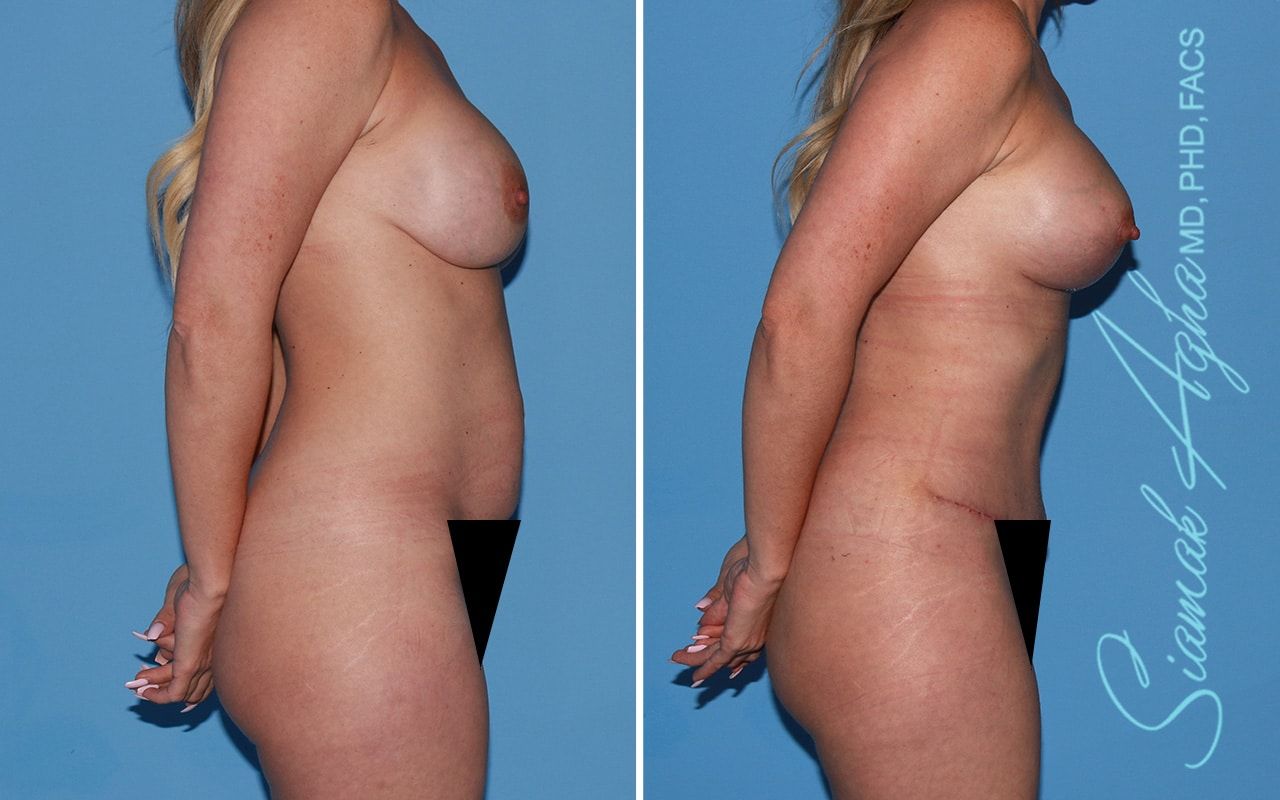 Mommy Makeover Before & After