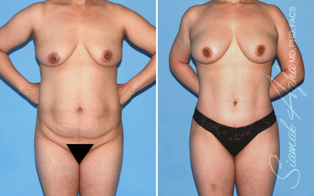 Mommy Makeover Before & After