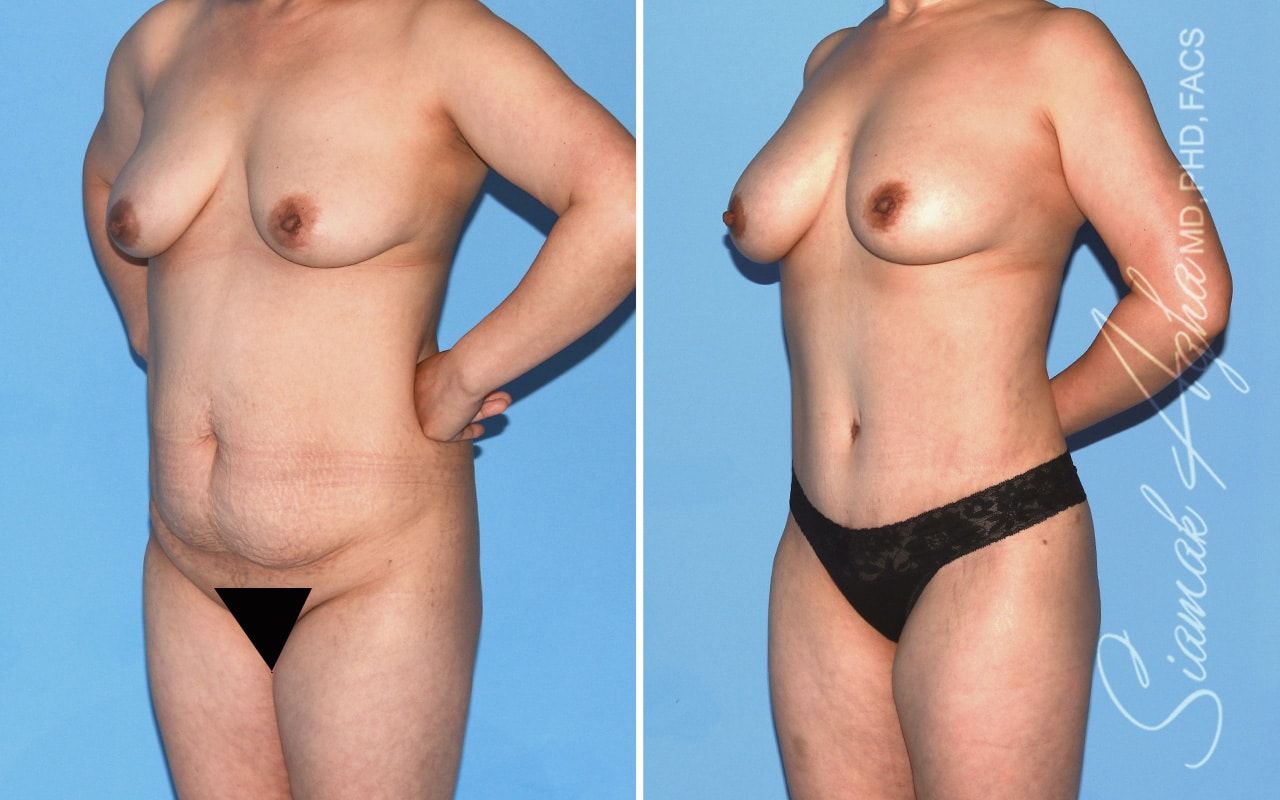 Mommy Makeover Before & After