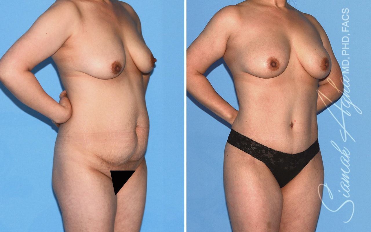 Mommy Makeover Before & After