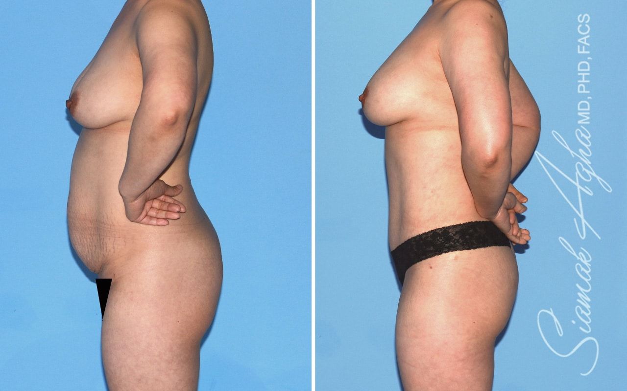 Mommy Makeover Before & After