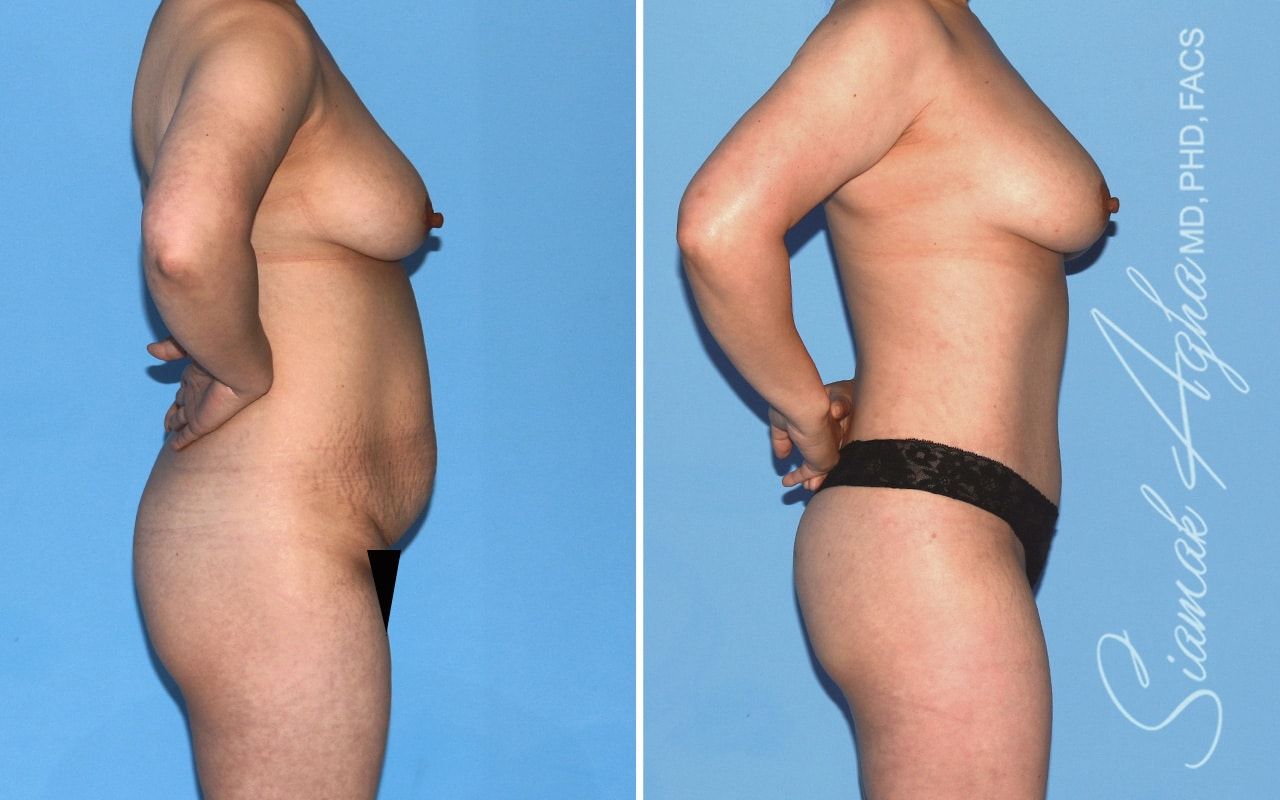 Mommy Makeover Before & After