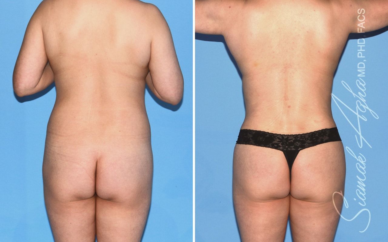 Mommy Makeover Before & After