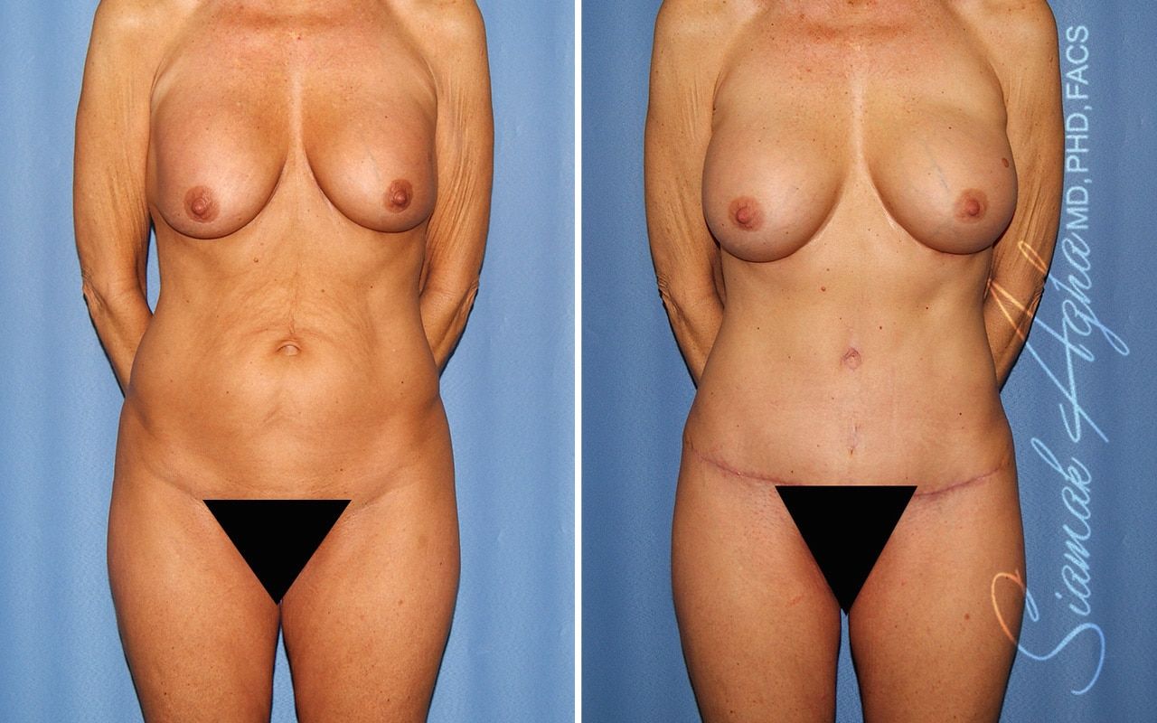 Mommy Makeover Before & After