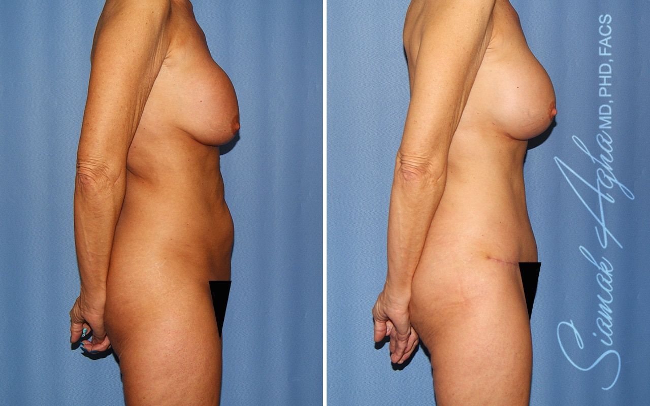 Mommy Makeover Before & After