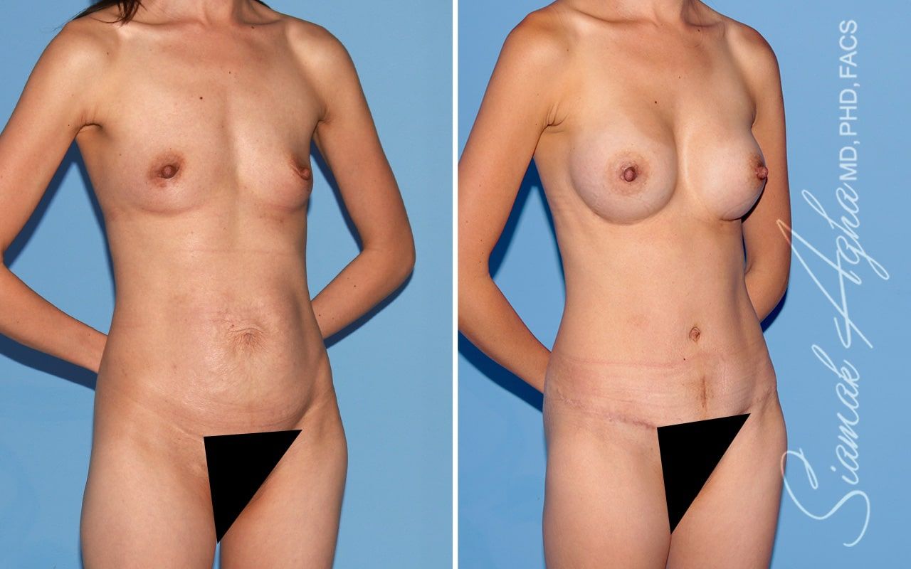 Mommy Makeover Before & After