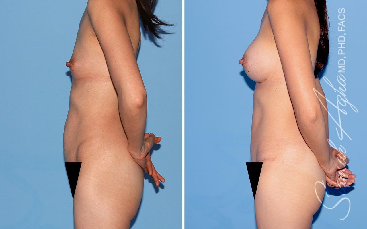 Mommy Makeover Before & After