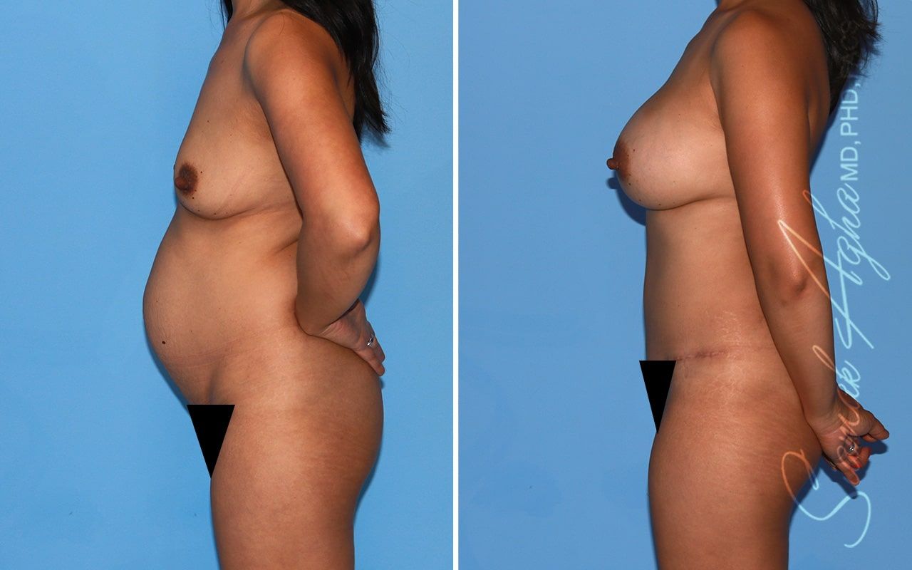 Mommy Makeover Before & After