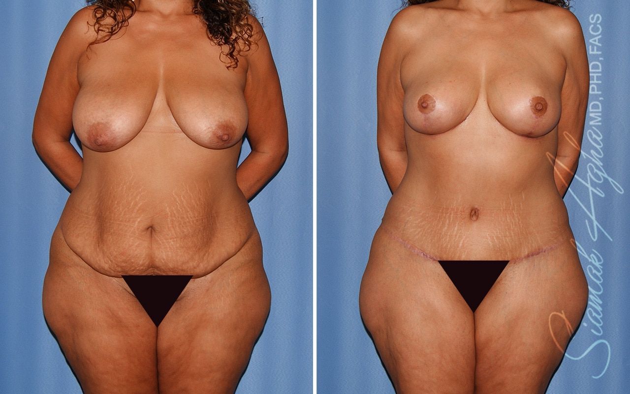 Mommy Makeover Before & After