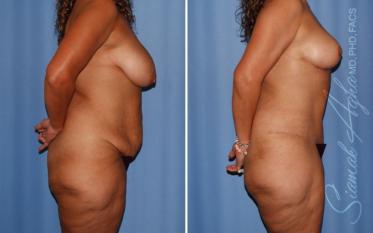 Mommy Makeover Before & After