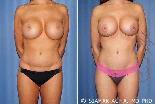 Mommy Makeover Before & After