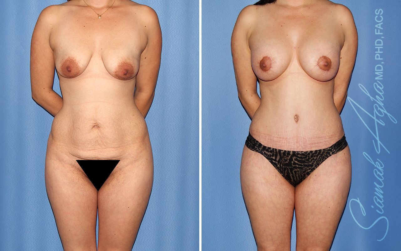 Mommy Makeover Before & After