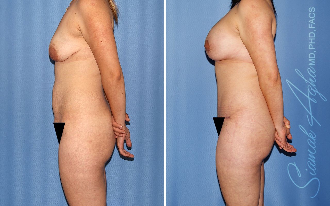 Mommy Makeover Before & After