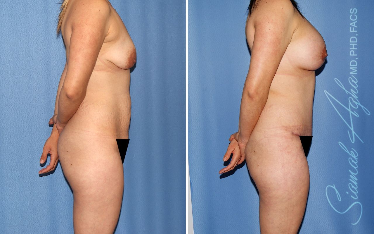 Mommy Makeover Before & After