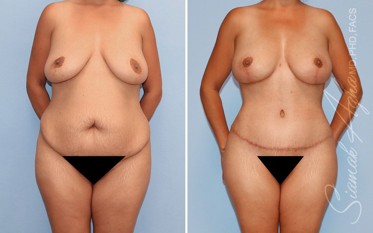 Mommy Makeover Before & After