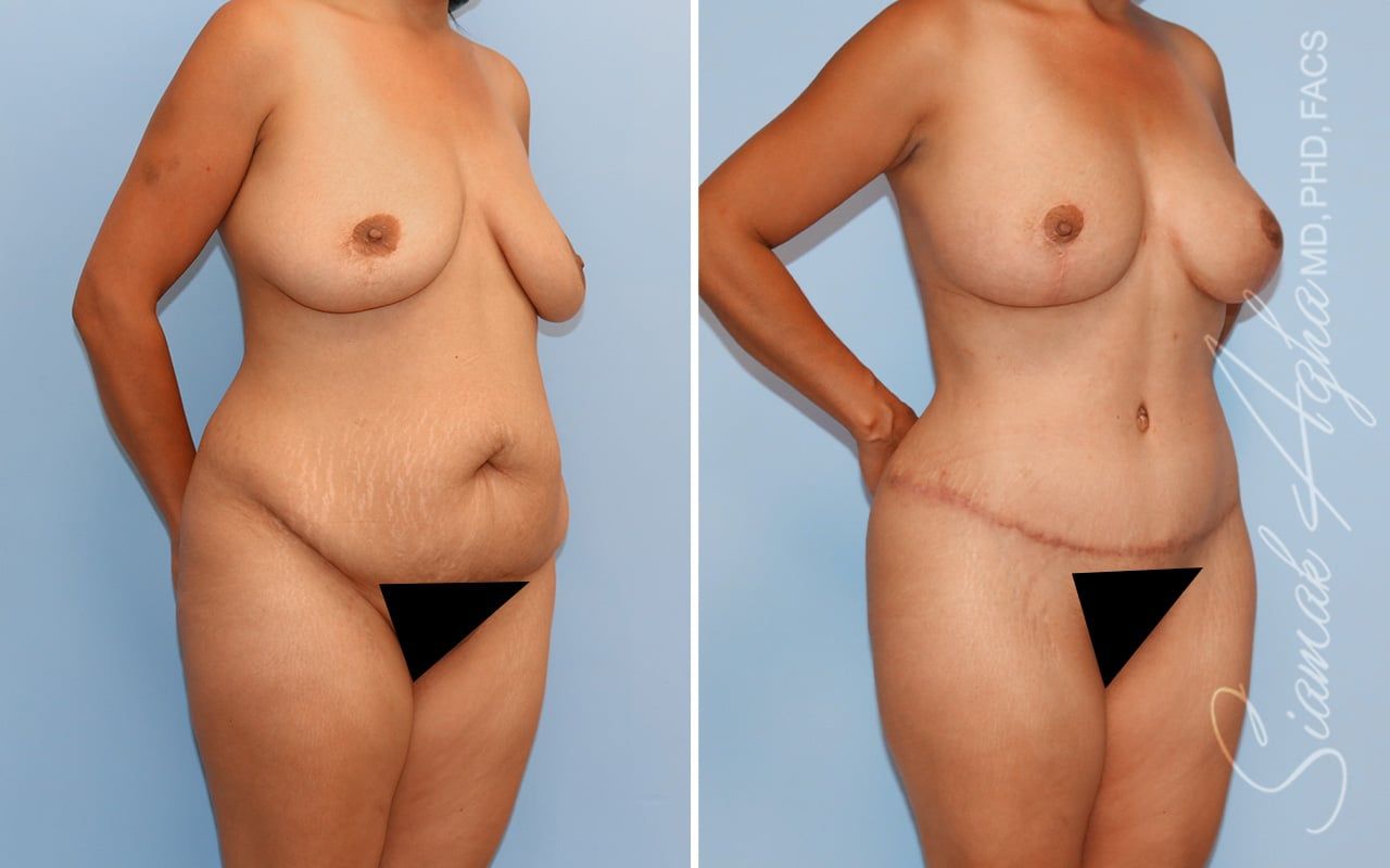 Mommy Makeover Before & After