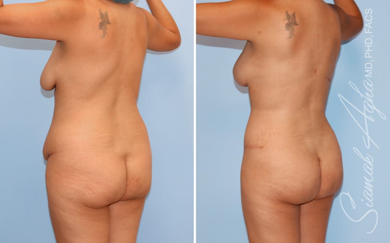 Mommy Makeover Before & After