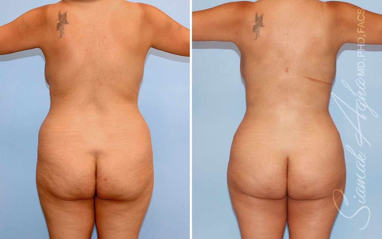 Mommy Makeover Before & After