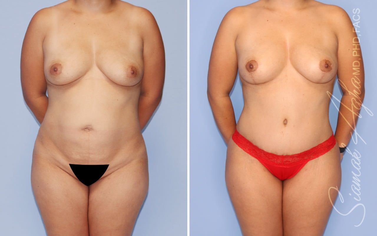 Mommy Makeover Before & After