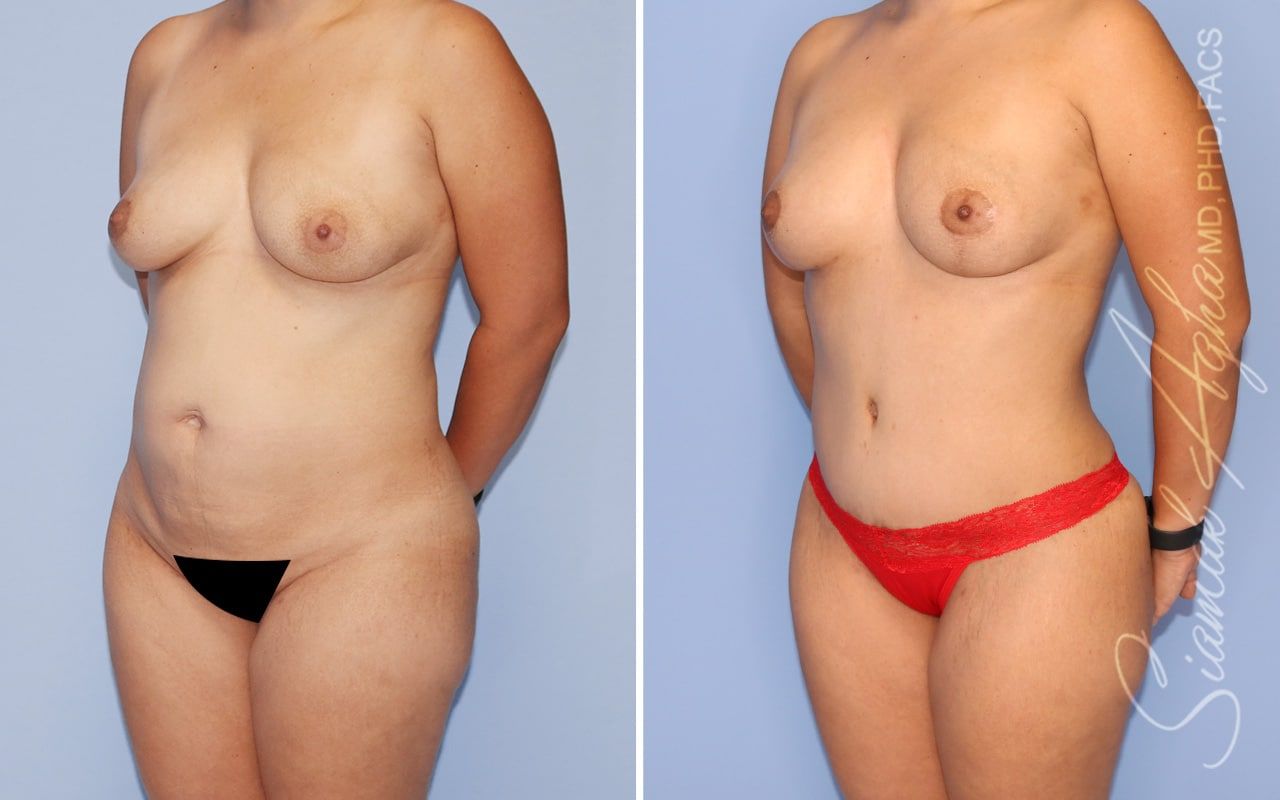 Mommy Makeover Before & After