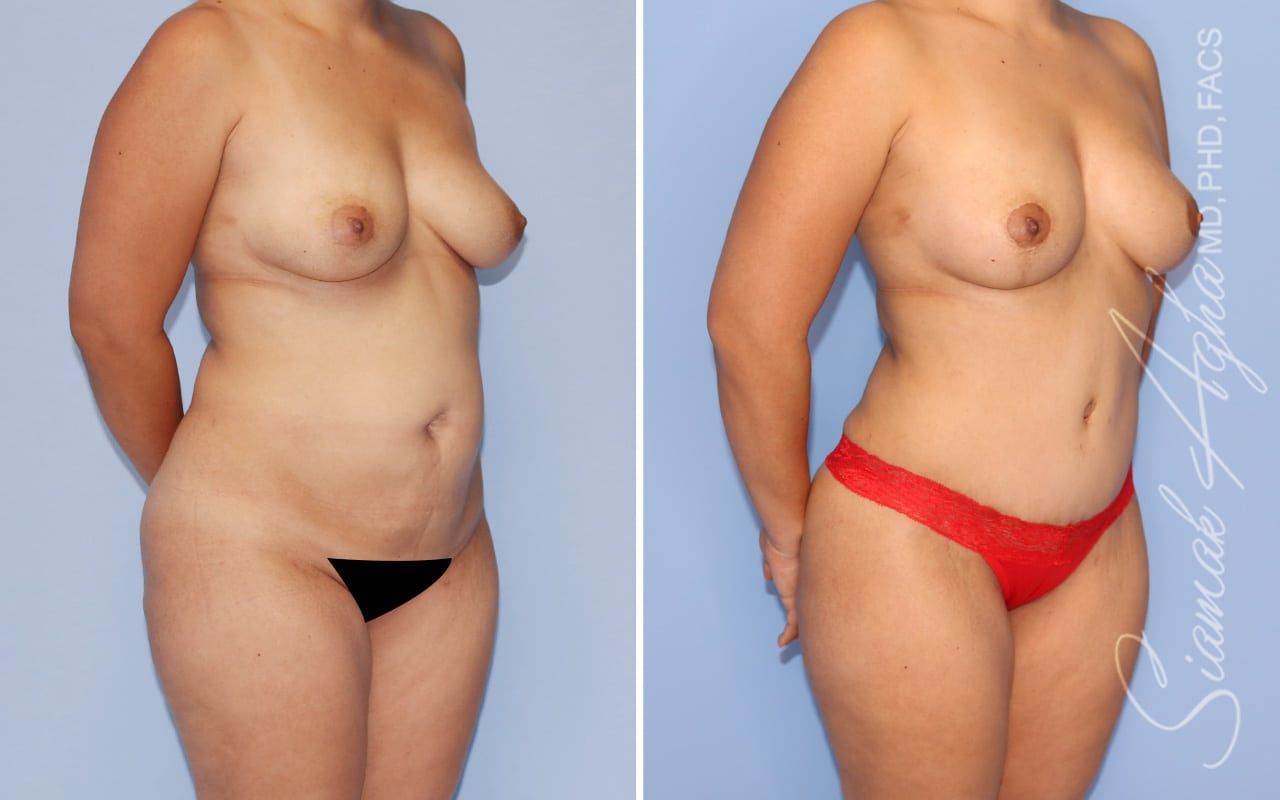 Mommy Makeover Before & After