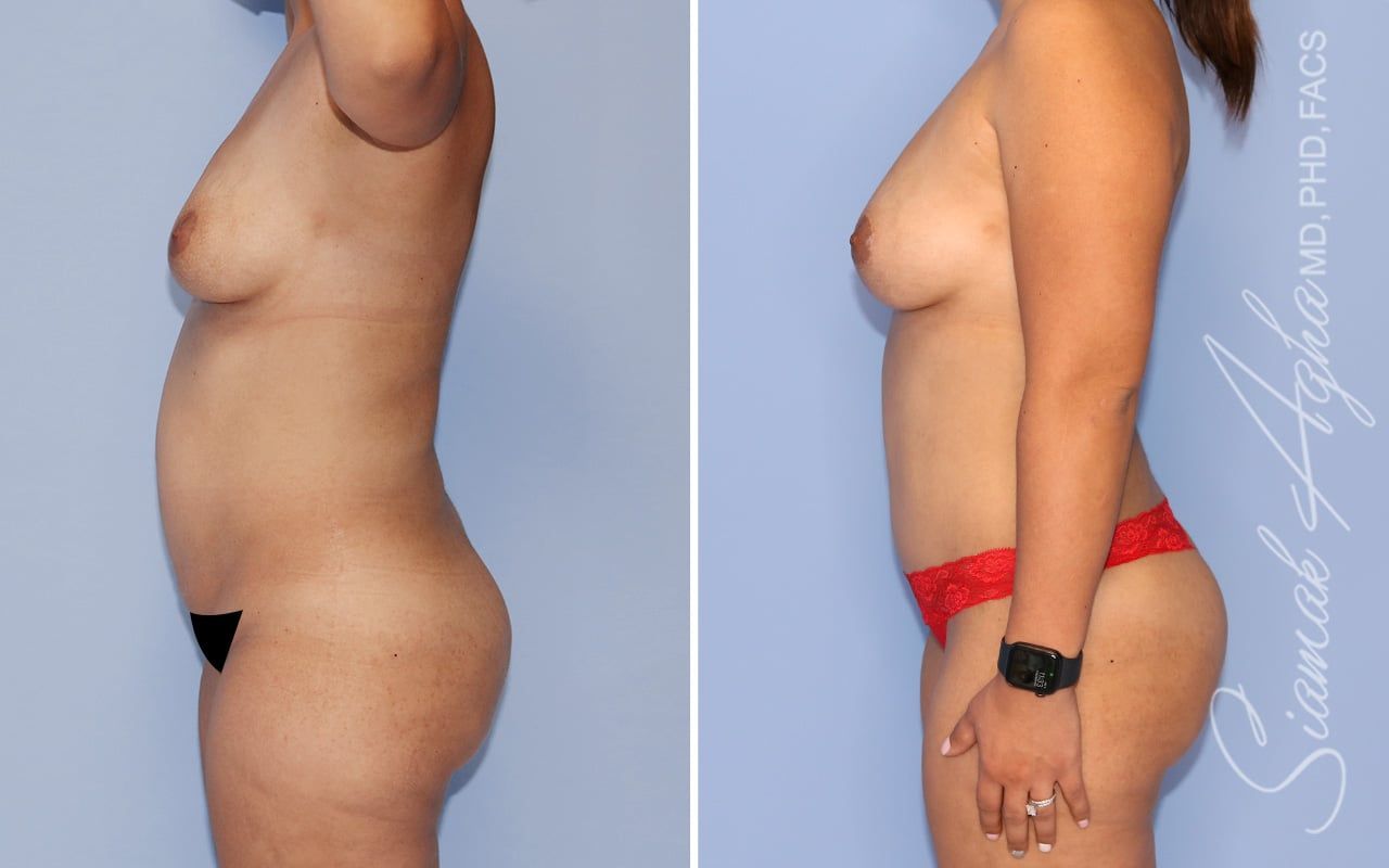 Mommy Makeover Before & After