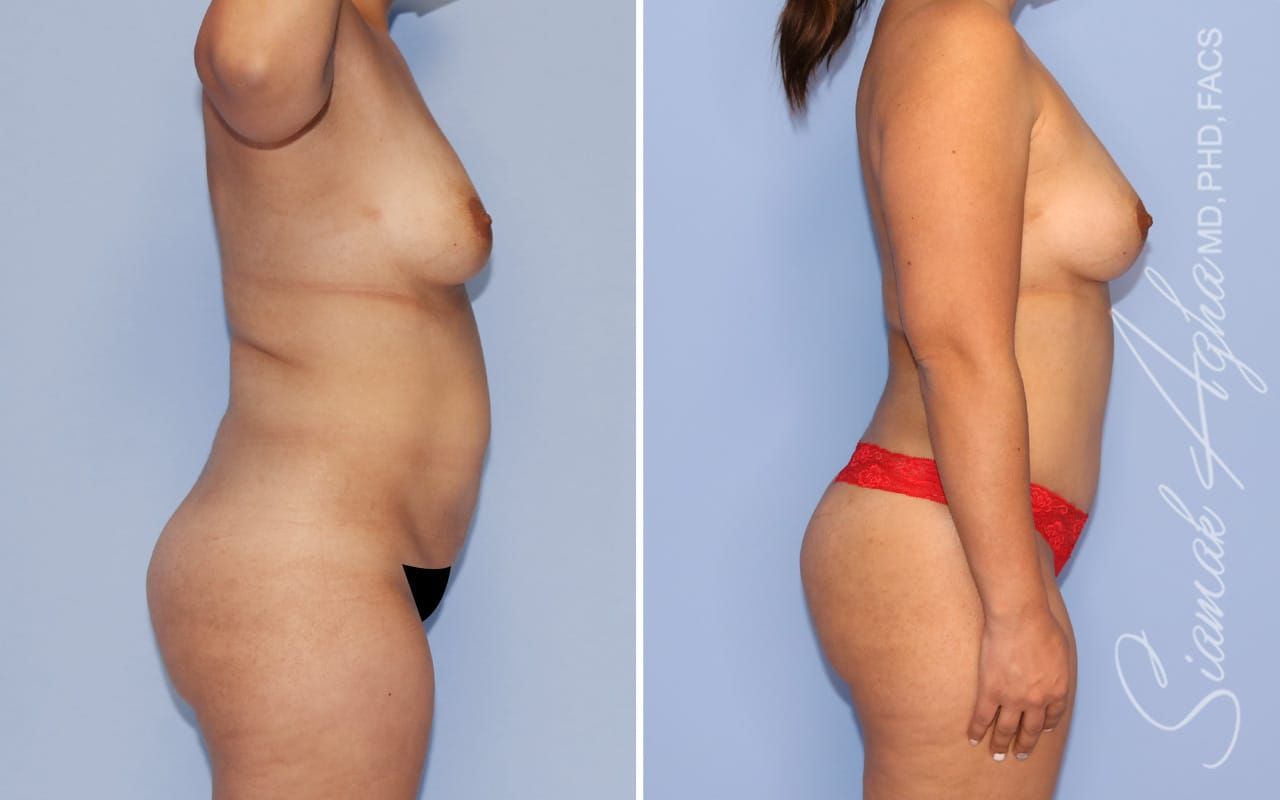 Mommy Makeover Before & After