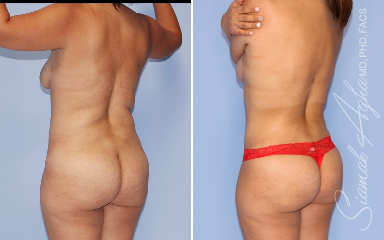 Mommy Makeover Before & After