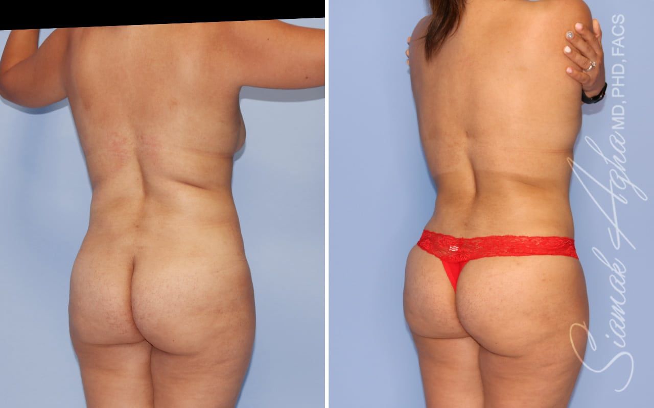 Mommy Makeover Before & After