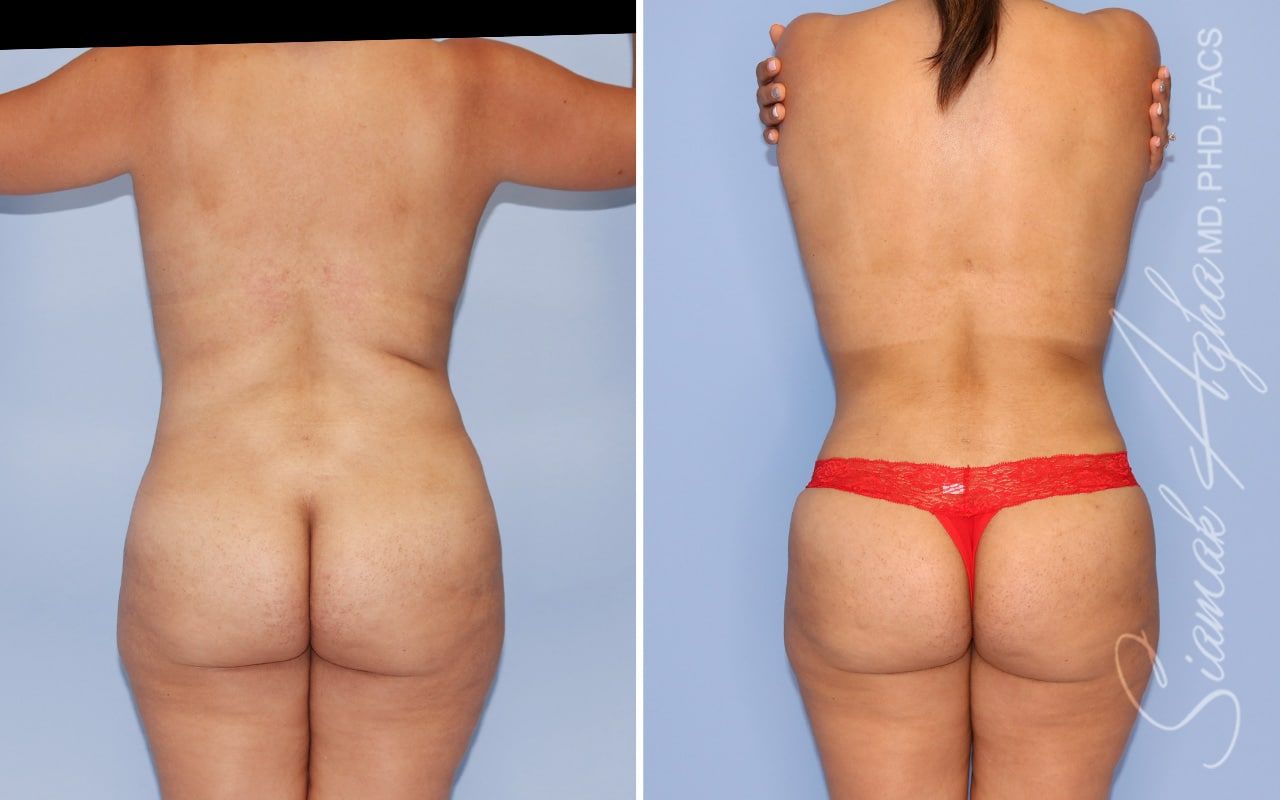 Mommy Makeover Before & After