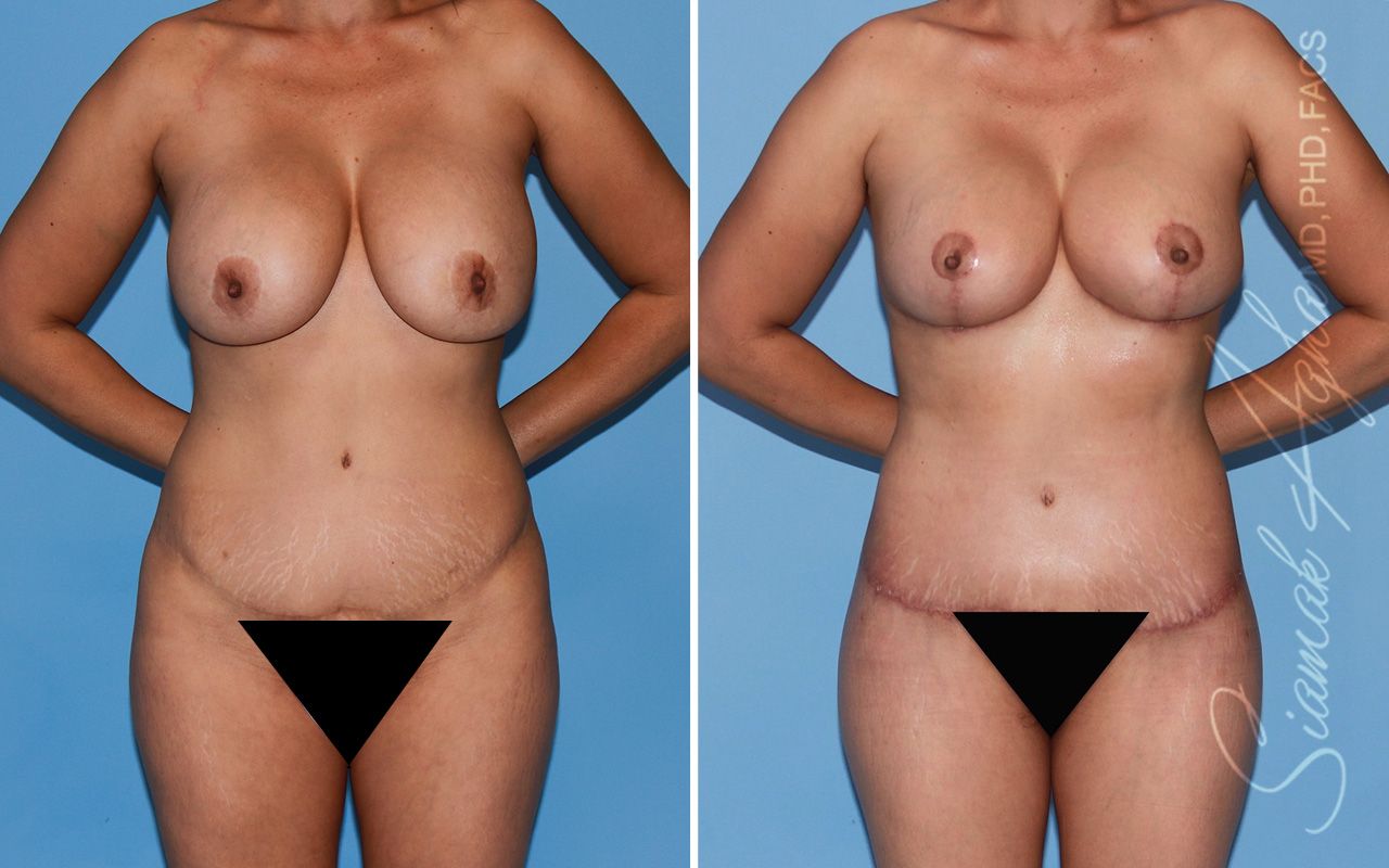 Mommy Makeover Before & After