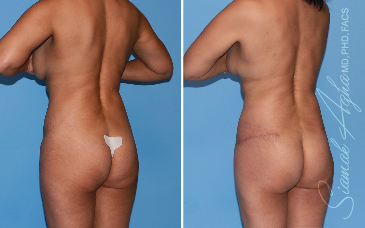 Mommy Makeover Before & After