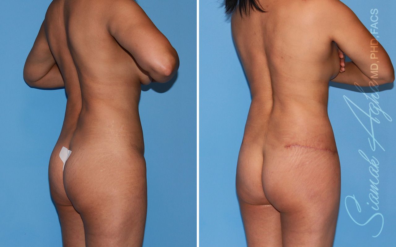 Mommy Makeover Before & After