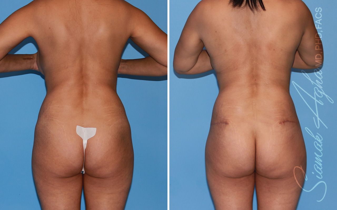 Mommy Makeover Before & After