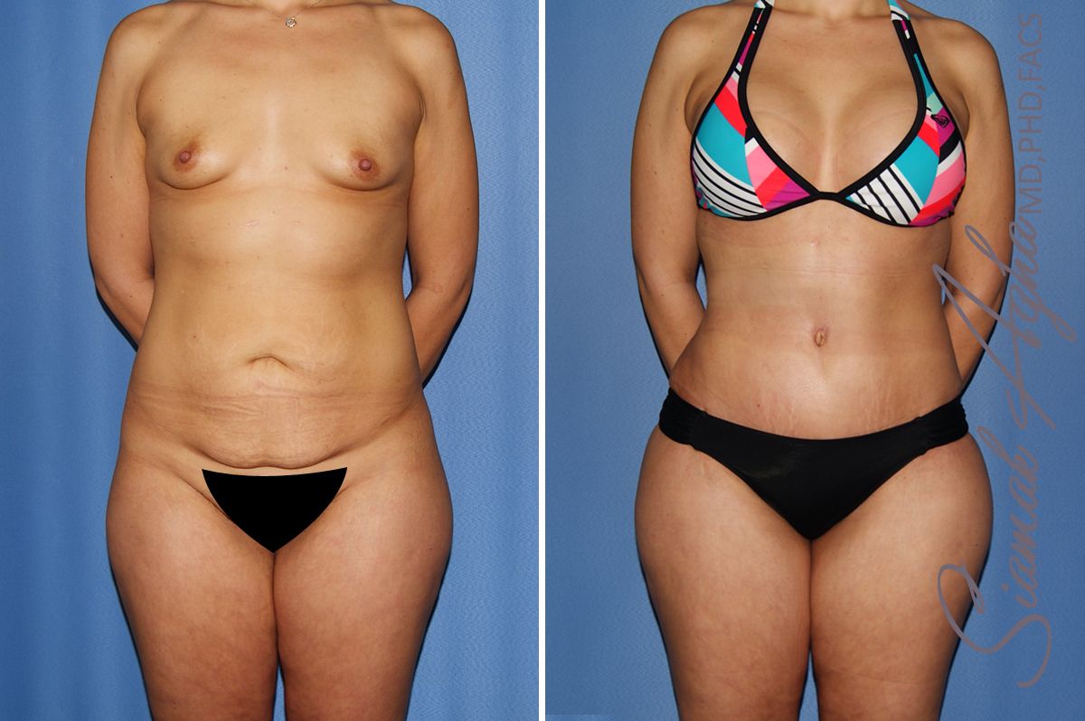 Mommy Makeover Before & After