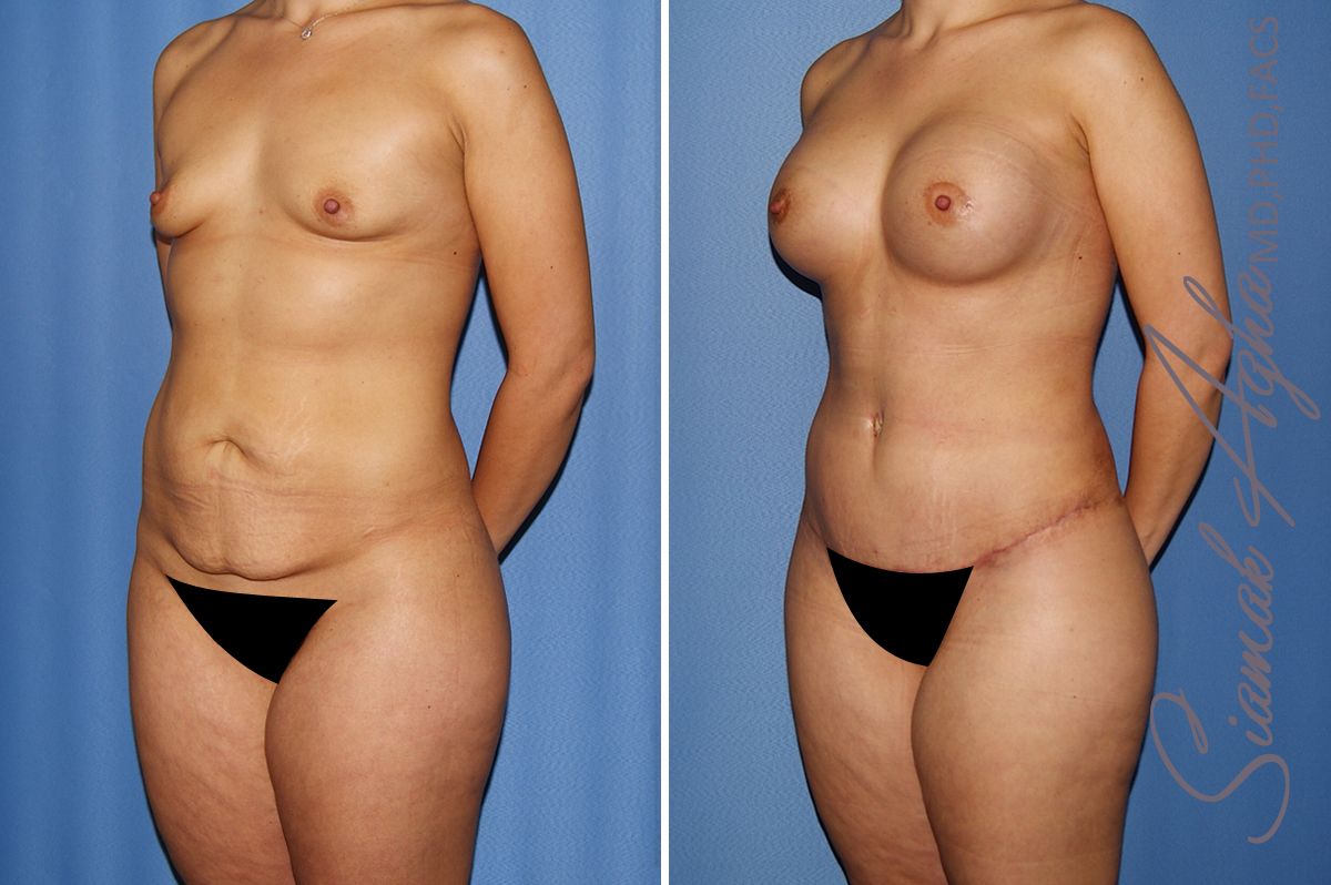 Mommy Makeover Before & After