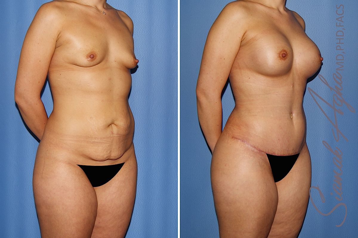 Mommy Makeover Before & After