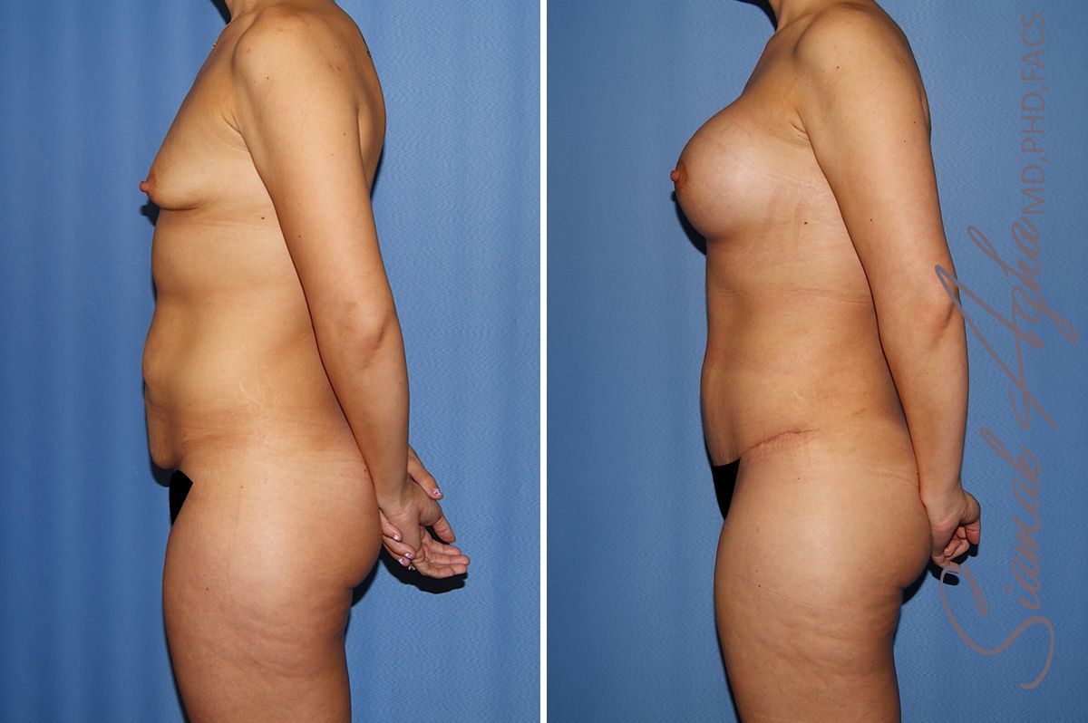 Mommy Makeover Before & After