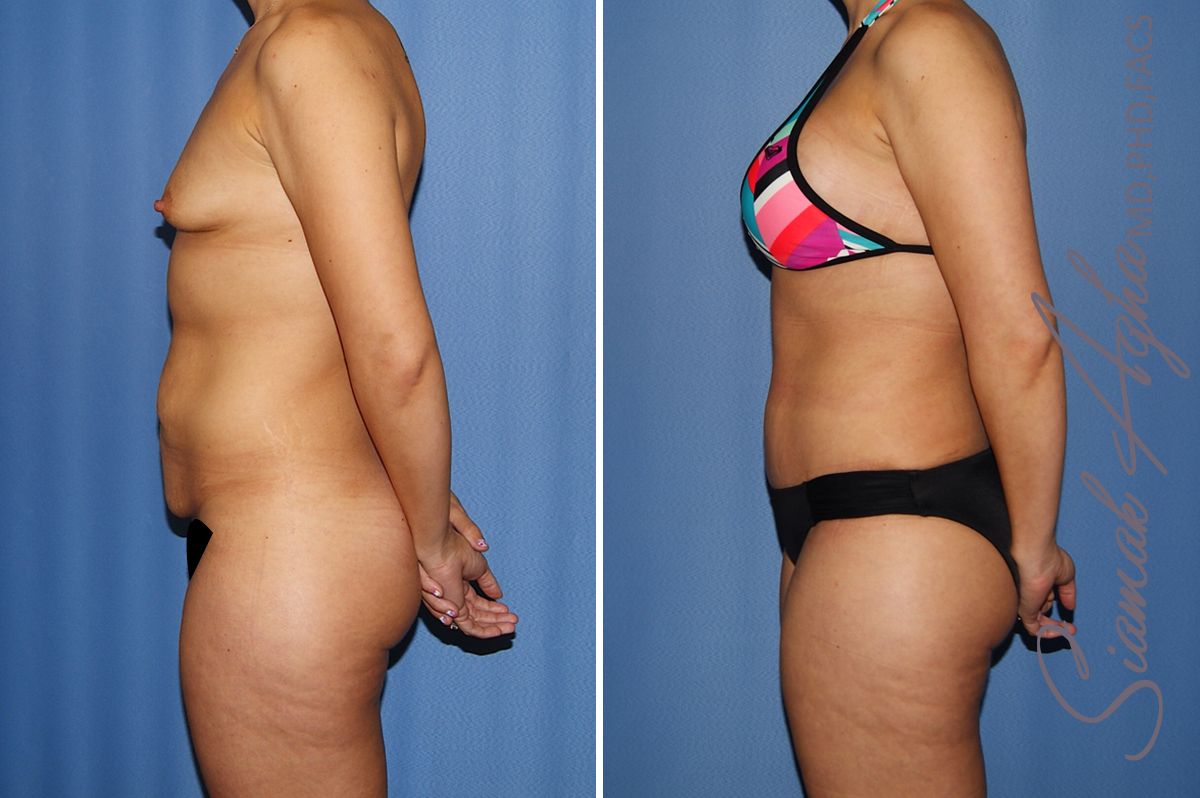 Mommy Makeover Before & After