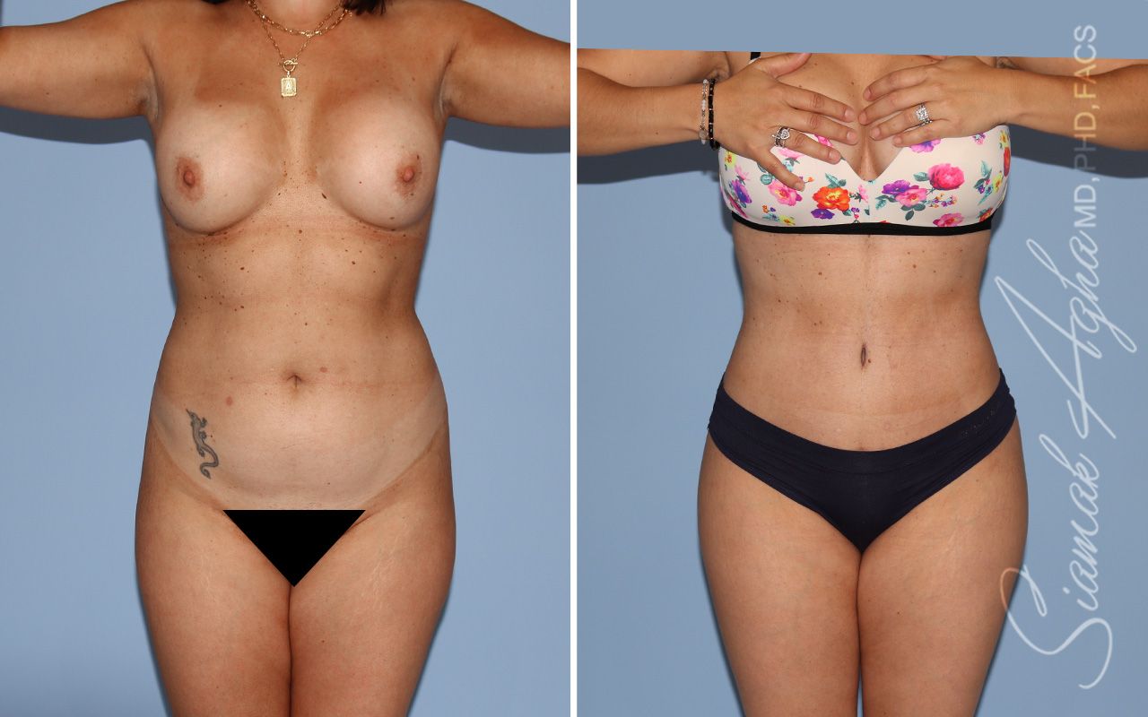 Mommy Makeover Before & After