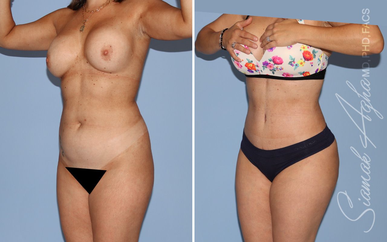 Mommy Makeover Before & After