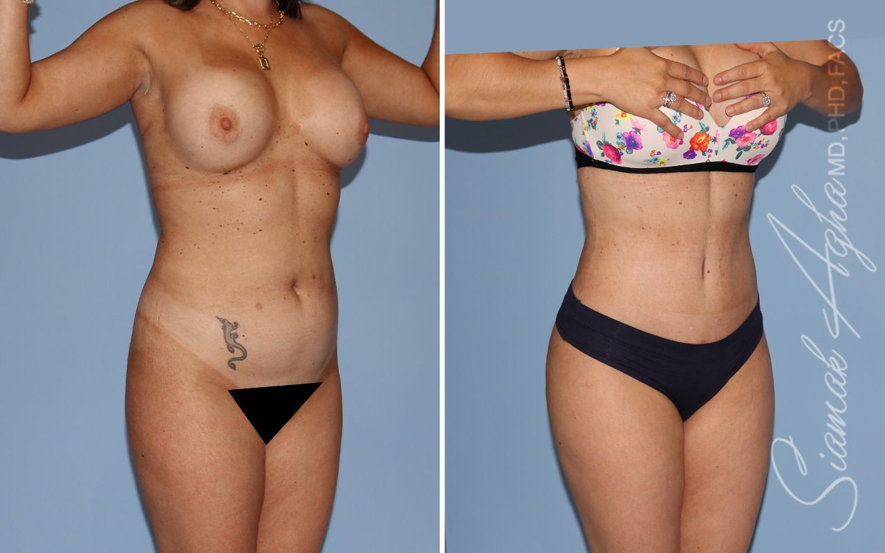 Mommy Makeover Before & After