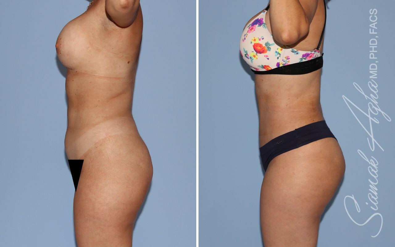 Mommy Makeover Before & After