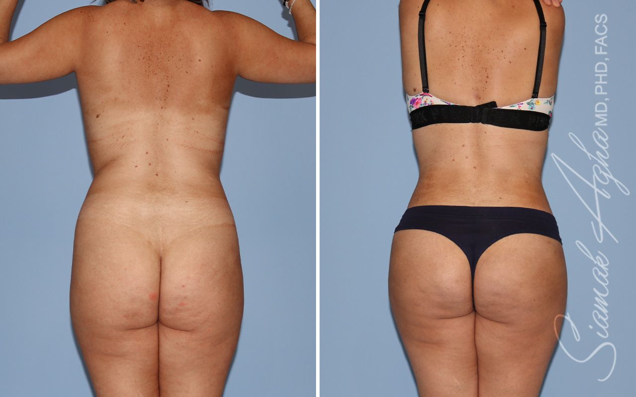 Mommy Makeover Before & After