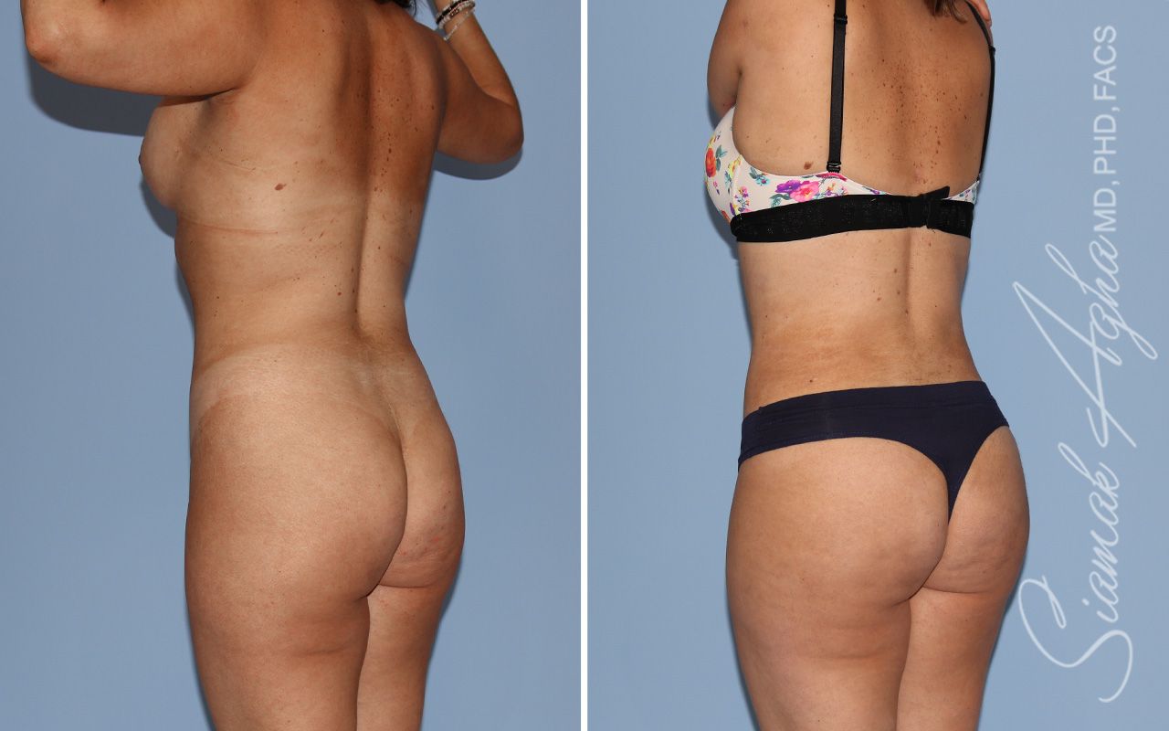 Mommy Makeover Before & After