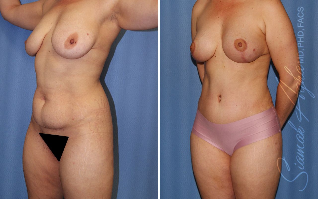 Mommy Makeover Before & After