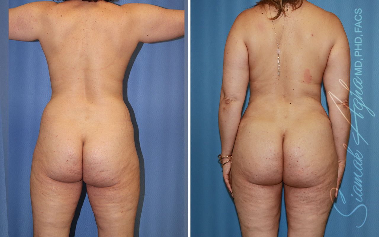 Mommy Makeover Before & After