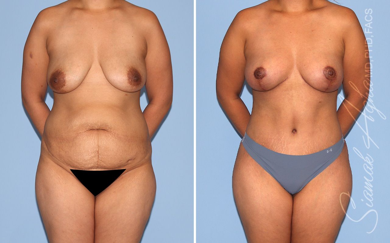 Mommy Makeover Before & After